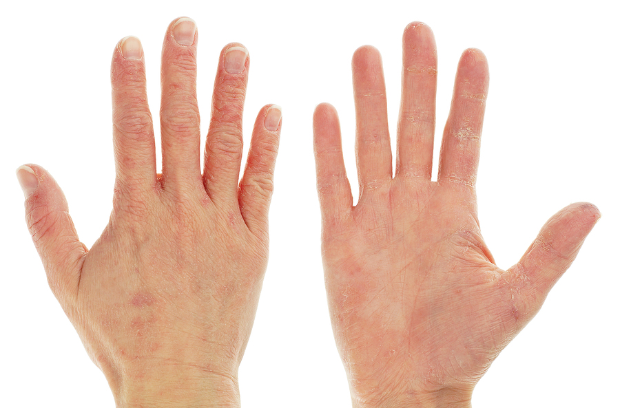 Allergic rashes caused by Apple (AAPL) iPad, dermatologists claim